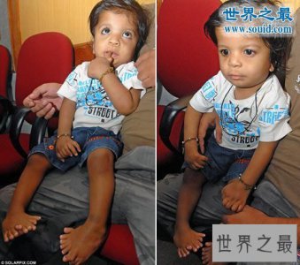 ​世界上手指脚趾最多的人，印度婴儿14个手指/20脚趾